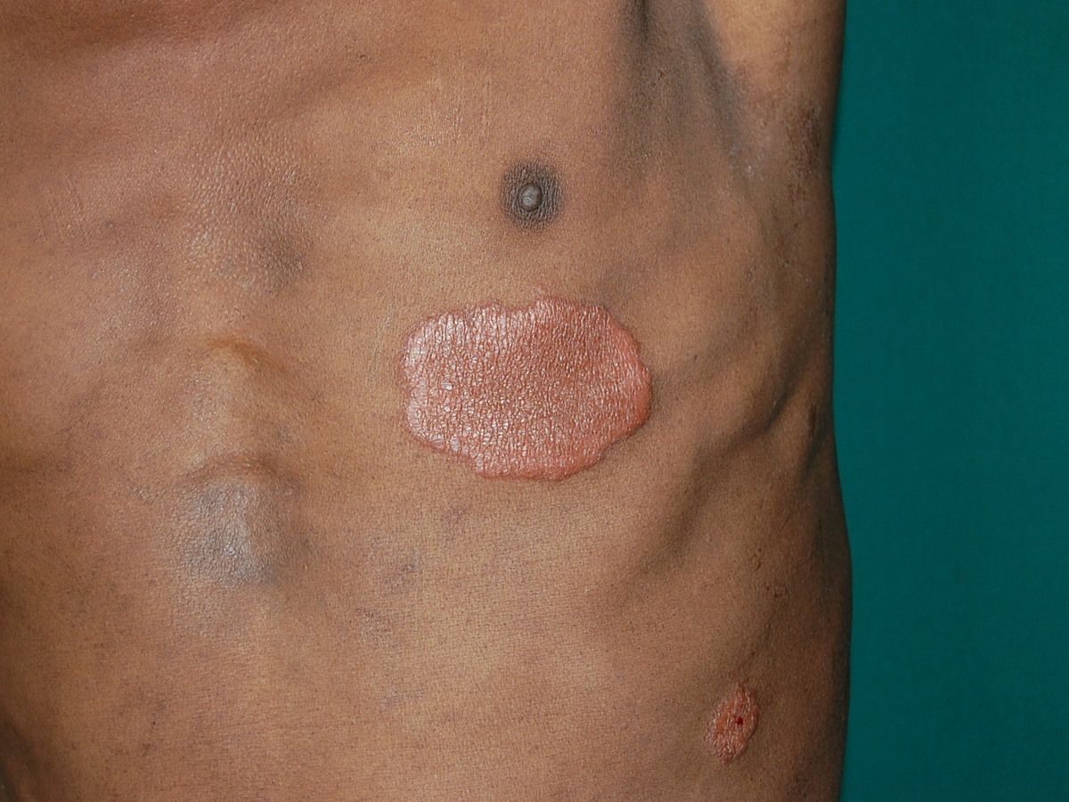 tuberculoid leprosy symptoms