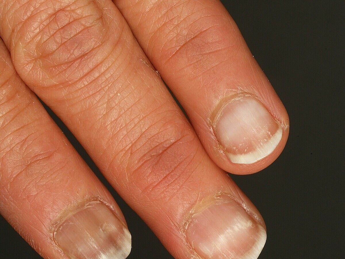 Striated leukonychia - Altmeyers Encyclopedia - Department Dermatology Striated leukonychia - Altmeyers Encyclopedia - Department Dermatology