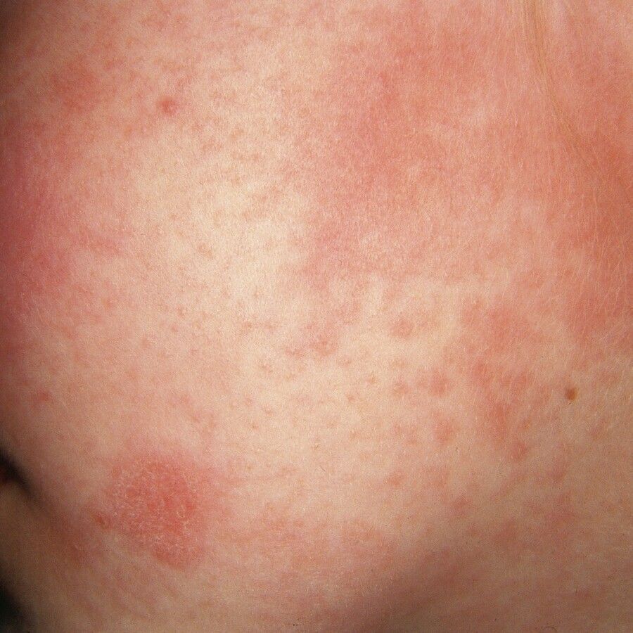 Kontakturtikaria - Altmeyers Enzyklopdie - Fachbereich Allergologie