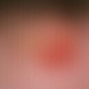 Kryptokokkose der Haut:  Von rötlichem, leicht erhabenem Randsaum umgebene, ca. 3 x 3 cm große, k...