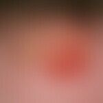 Kryptokokkose der Haut:  Von rötlichem, leicht erhabenem Randsaum umgebene, ca. 3 x 3 cm große, k...