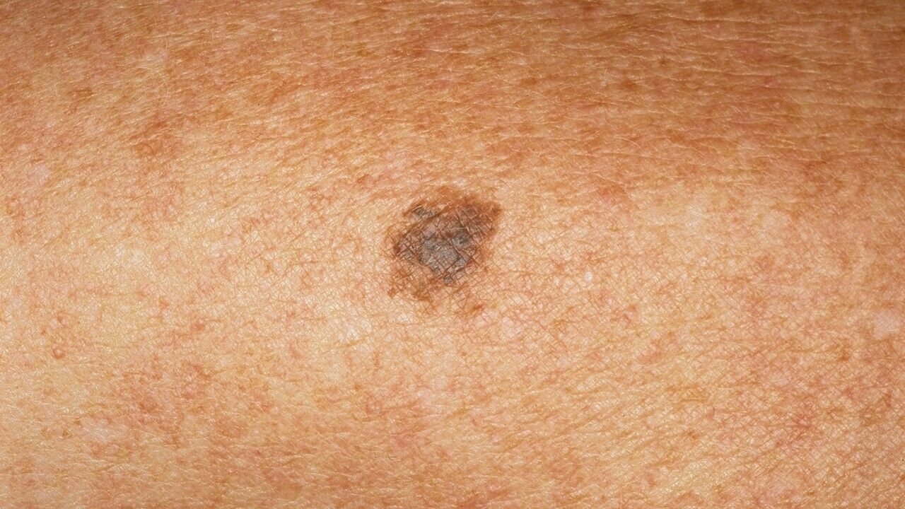 Lentigo Maligna Prognosis