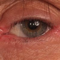 Eyelid dermatitis (overview) Images - Altmeyers Encyclopedia ...