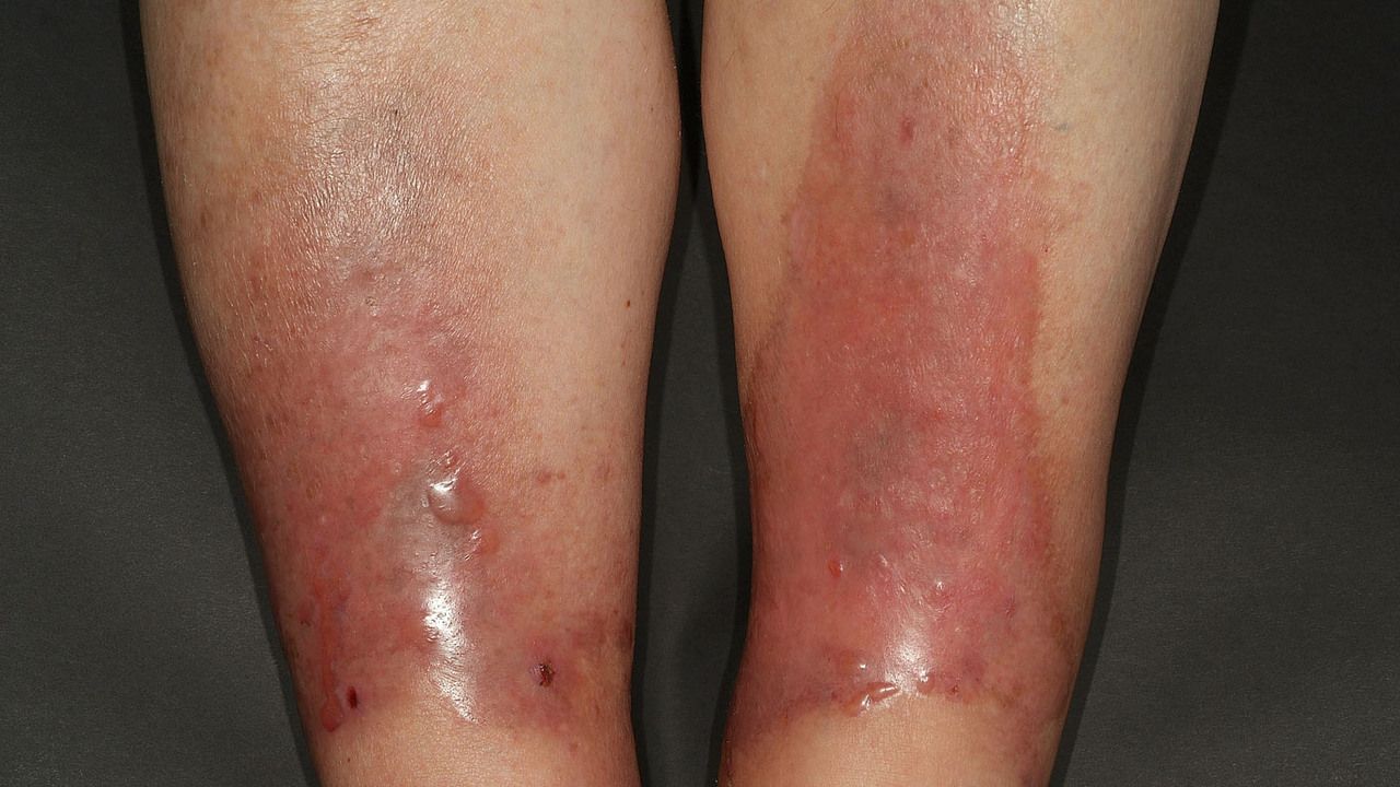 Eruptive psoriasis fotó