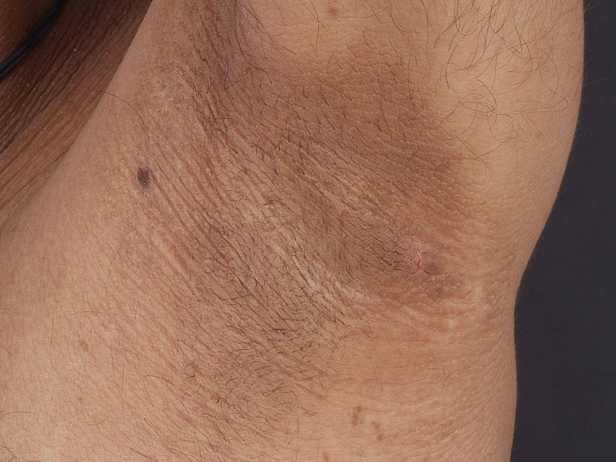 Acanthosis nigricans (overview) - Altmeyers Encyclopedia - Department Dermatology