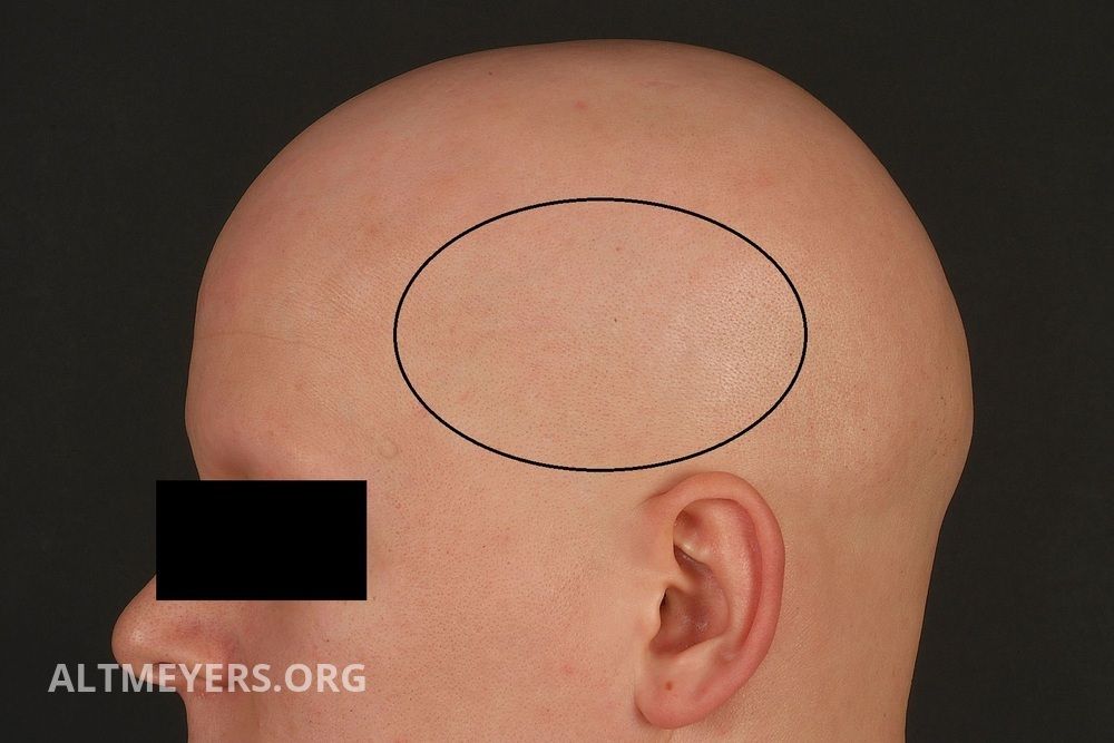 Alopecia Areata Totalis Altmeyers Encyclopedia Department Dermatology 