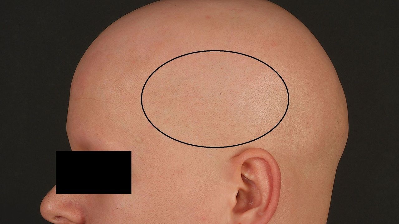 helmintikus terápia alopecia areata)