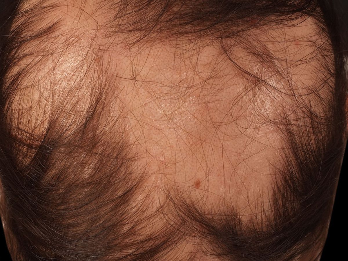 Alopecia areata (overview) - Altmeyers Encyclopedia - Department Dermatology