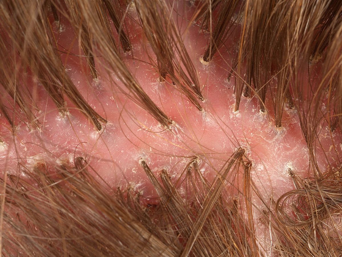 Synonym For Tuft Of Hair Synonym For Tuft Of Hair