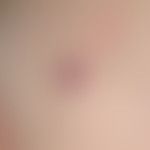 Angioma senile. red brown, very soft papules, almost completely compressible by finger pressure, ...