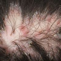 Folliculitis decalvans Images - Altmeyers Encyclopedia - Department ...