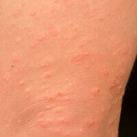 Pityriasis lichenoides (et varioliformis) acuta Images - Altmeyers ...