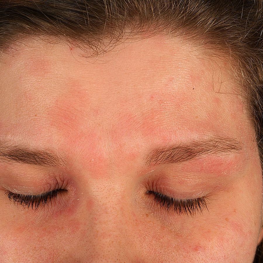 Liddermatitis Ubersicht Altmeyers Enzyklopadie Fachbereich Dermatologie