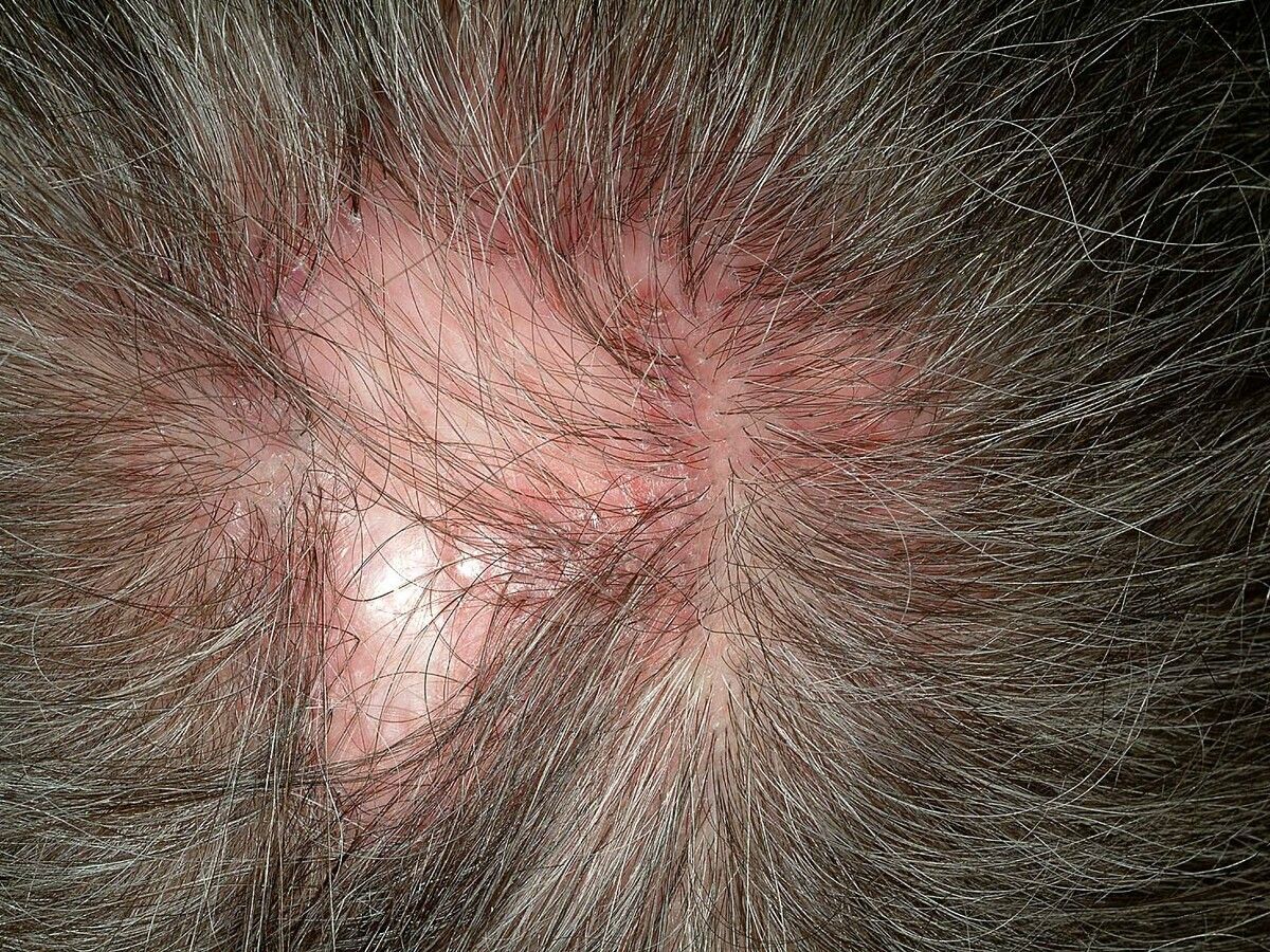 Folliculitis Decalvans Altmeyers Enzyklopadie Fachbereich Dermatologie