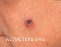 Perioral Dermatitis? Gram Negative Folliculitis? Tinea Barbae