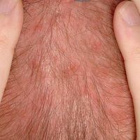 Folliculitis superficial Images - Altmeyers Encyclopedia - Department ...