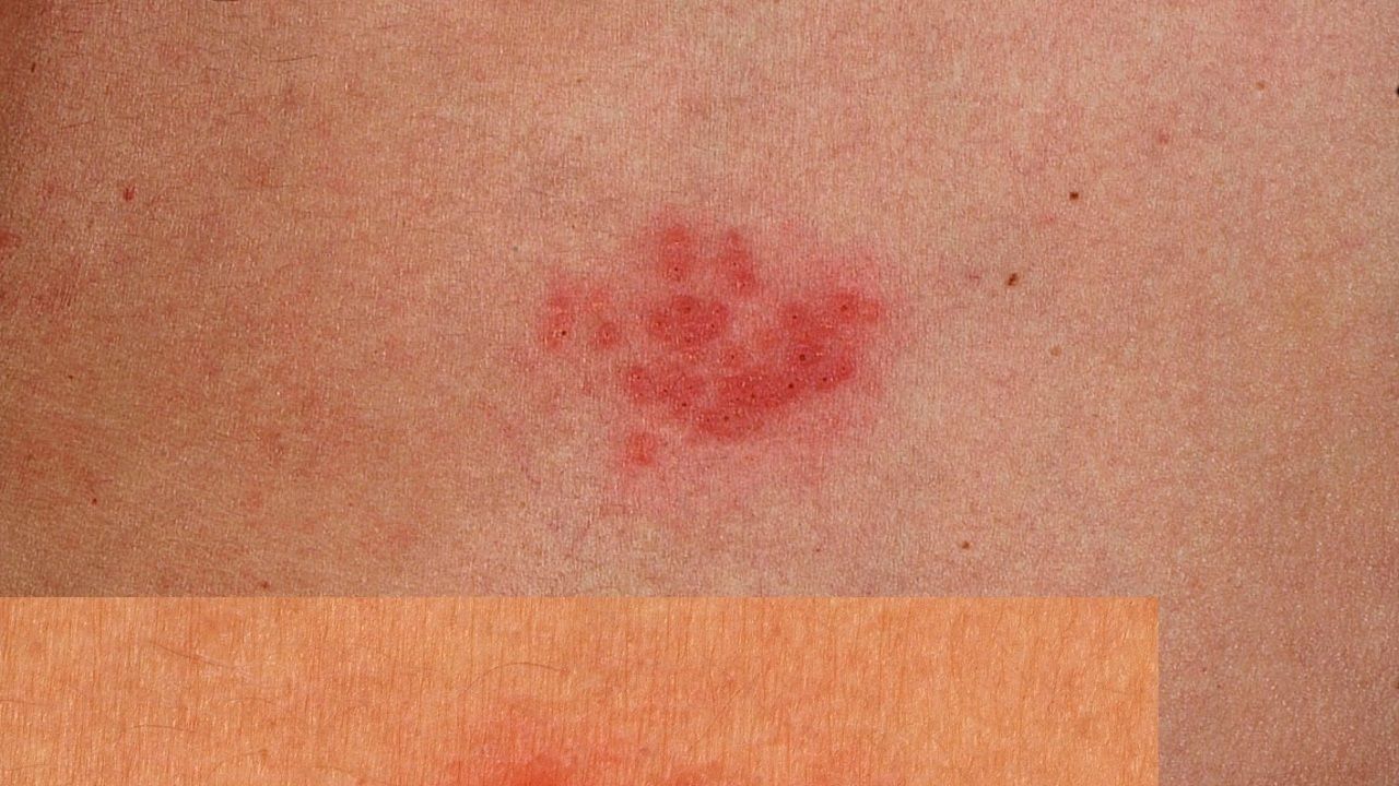 Herpes Simplex Recidivans Altmeyers Enzyklopadie Fachbereich Dermatologie