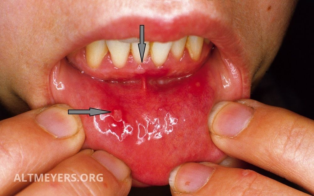 Herpangina Gums