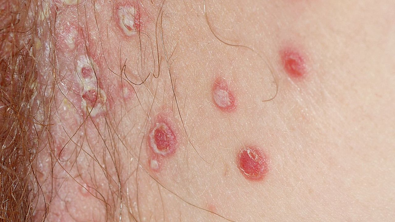 Herpes genitalis in der scheide
