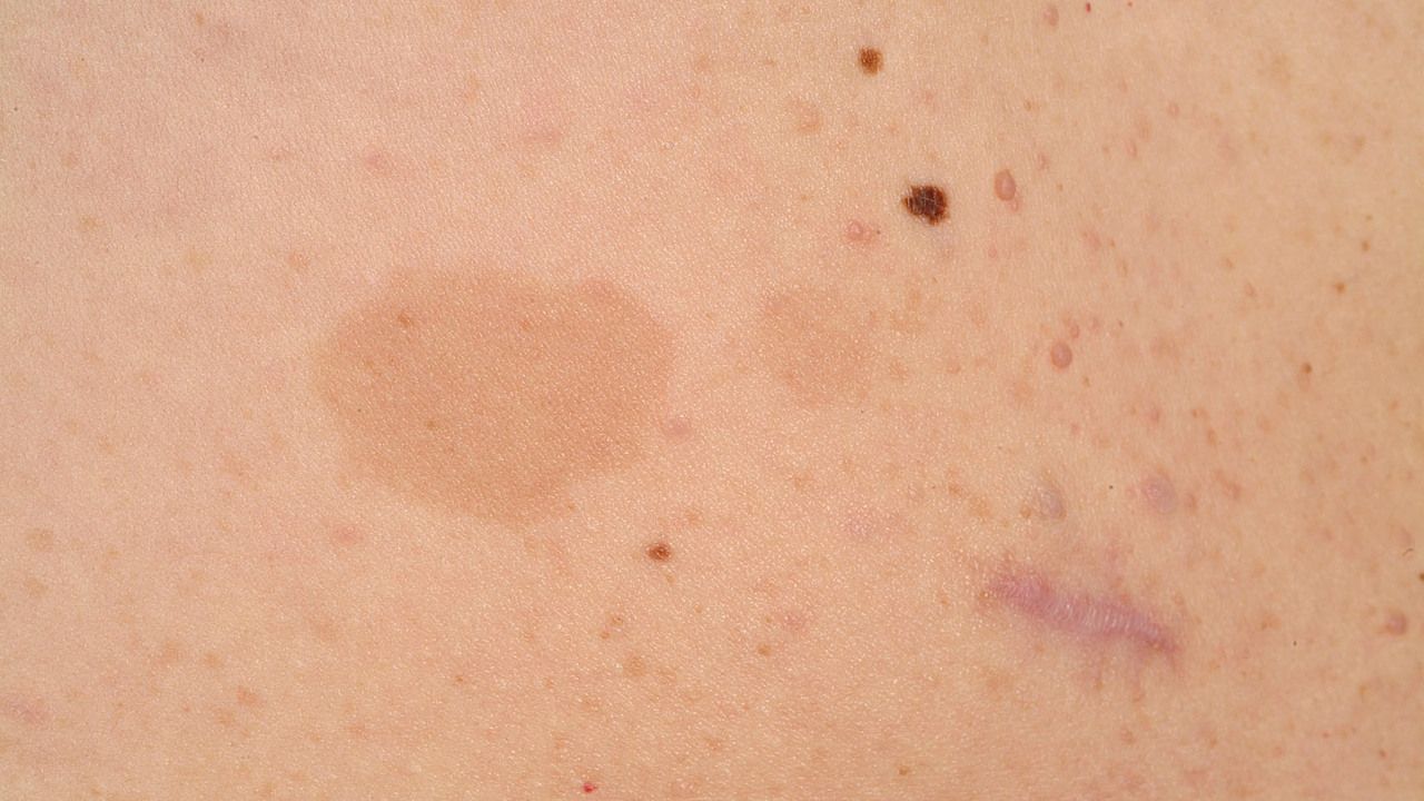 cafe au lait images macular rash