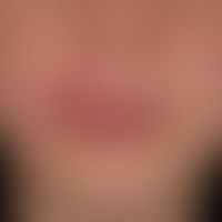 Differenzialdiagnose: Cheilitis simplex

Diagnose: vorliegend eine   Cheilitis granulomatosa mi...