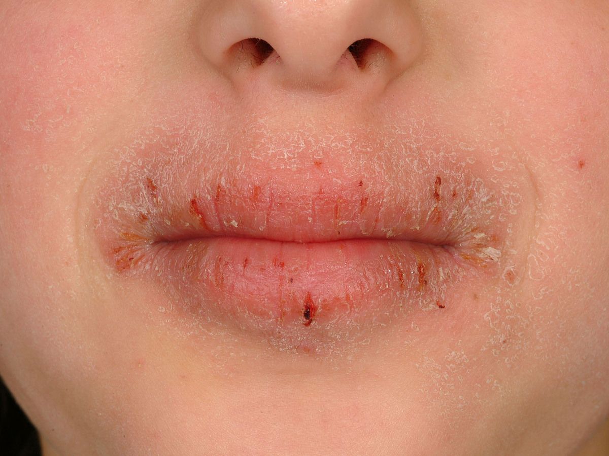 Der lippe stelle an trockene Mundschleimhaut ausgetrocknet?