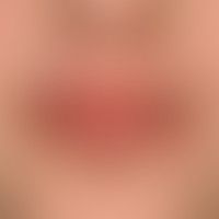 Lip Lick Eczema: Chronic cheilitis with scaling, painful radial rhagades in known atopic diathesi...