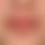 Chronic (atopic) cheilitis with perioral eczema: apart from dry skin and a known pollen sensitiza...
