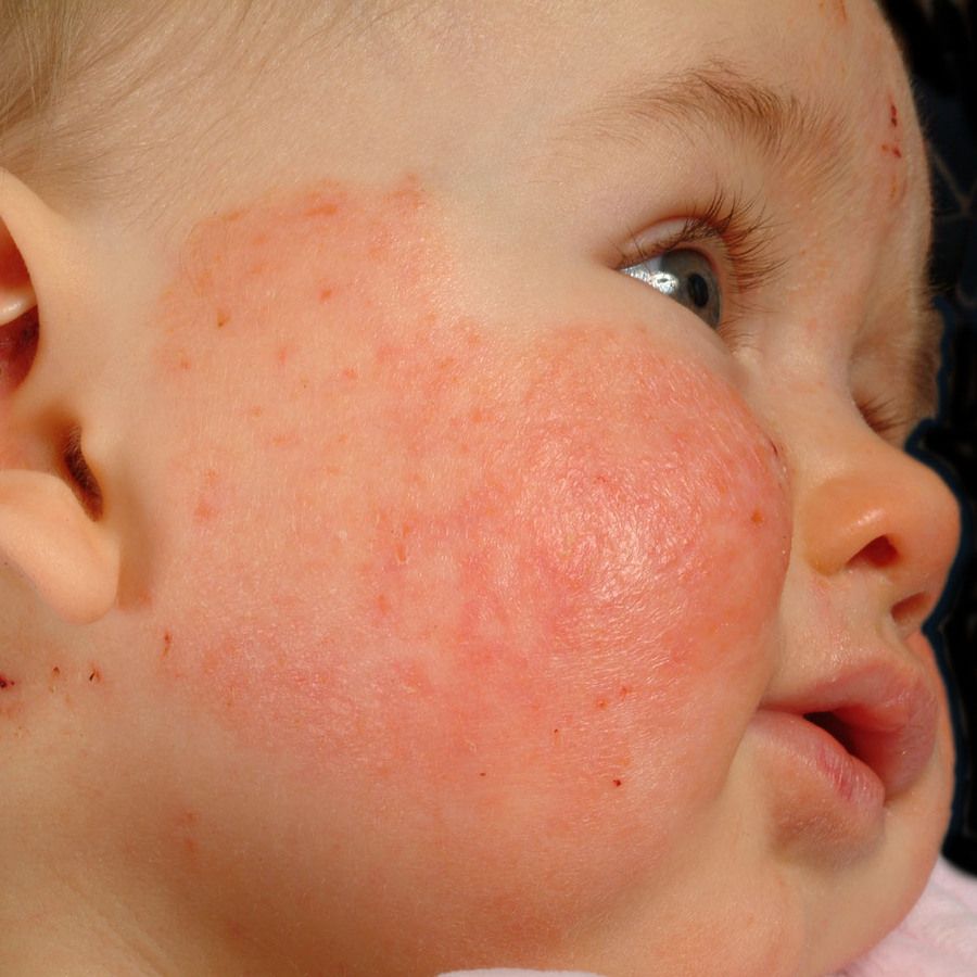 Atopic Dermatitis In Infancy Altmeyers Encyclopedia Department Dermatology