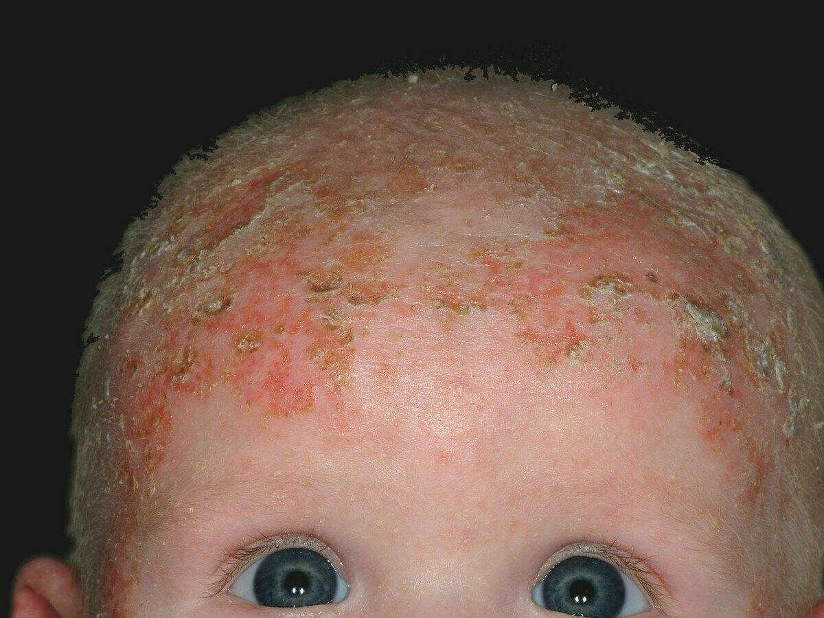 infantile seborrheic dermatitis face