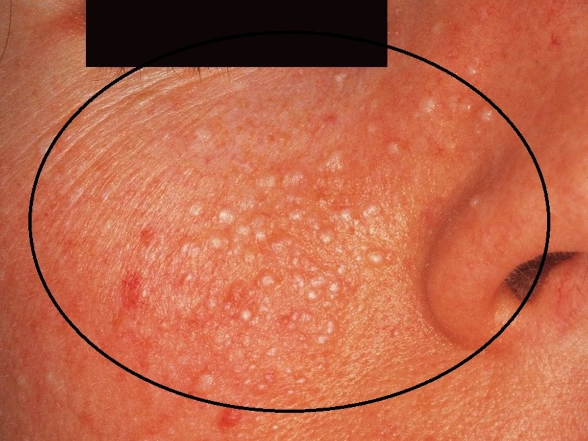 Milia En Plaque Altmeyers Encyclopedia Department Dermatology