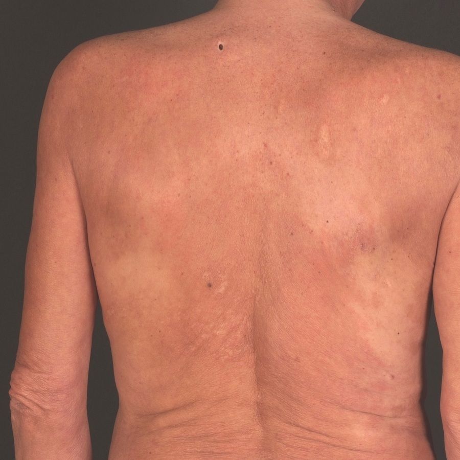 Tinea Corporis involving almost the entire back