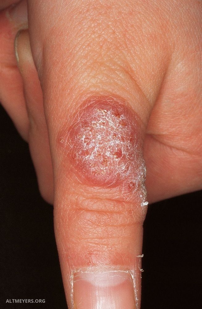 Nontuberculous Mycobacterioses (overview) - Altmeyers Encyclopedia - Department Internal medicine Nontuberculous Mycobacterioses (overview) - Altmeyers Encyclopedia - Department Internal medicine