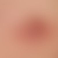 mastitis. solitary, acute, surrounding the areola mamillae, approx. 3.0 cm in size, blurredly lim...
