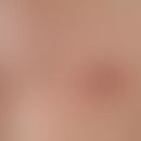mastitis. solitary, acute, surrounding the areola mamillae, approx. 3.0 cm in size, blurred, firm...