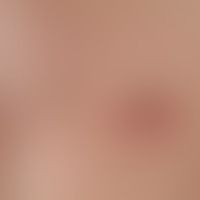 mastitis. solitary, acute, surrounding the areola mamillae, approx. 3.0 cm in size, blurred, firm...