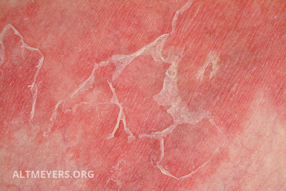 Scarlet Fever - American Osteopathic College of Dermatology (AOCD)