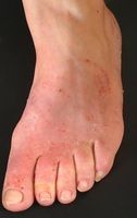 Tinea pedis moccasin type - Altmeyers Encyclopedia - Department Dermatology