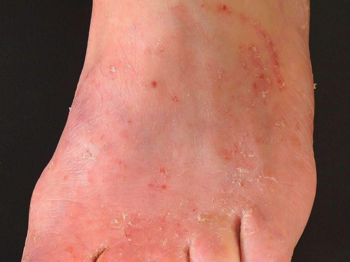 vesicular tinea pedis