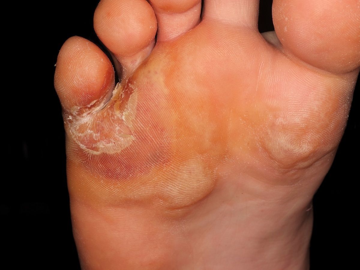 Complications from tinea pedis. Vesicles on the back of a foot
