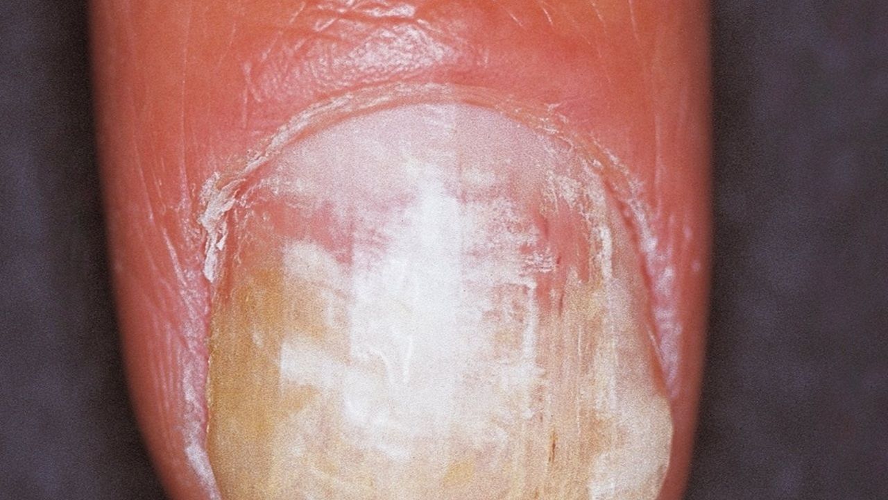 Premium Photo  Fungal nail infection onychomycosis also called tinea  unguium