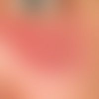 Lymphadenosis cutis benigna: a red, blurred, painless lump that has existed for several months, w...
