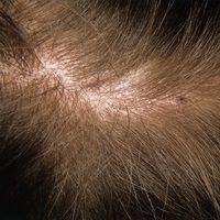 Tinea capitis superficialis Images - Altmeyers Encyclopedia ...