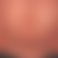 Pityriasis rubra pilaris (a... Pityriasis rubra pilaris (adulter Typ) Detailaufnahme: seit Jahren chronisch-rezidivierender Verl...
