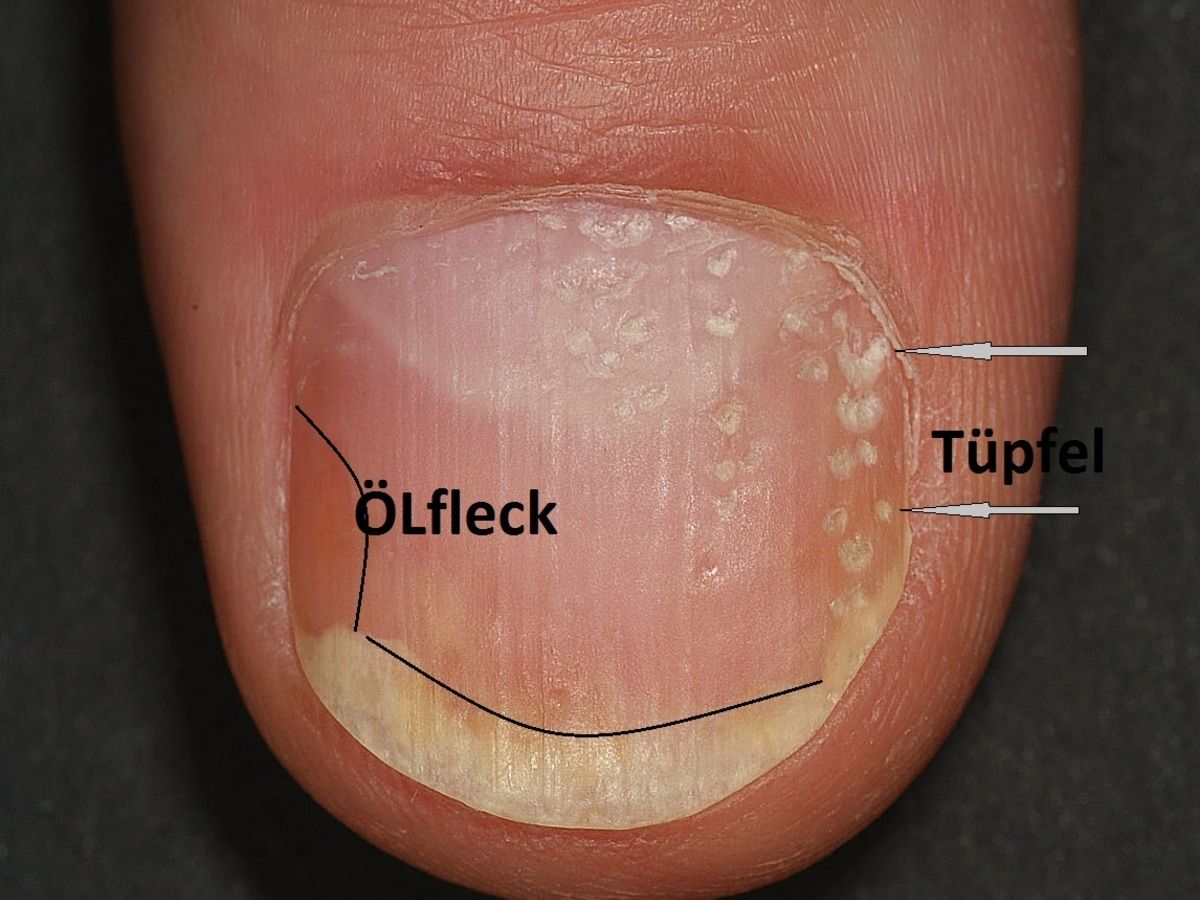 Psoriasis Der Nagel Altmeyers Enzyklopadie Fachbereich Dermatologie