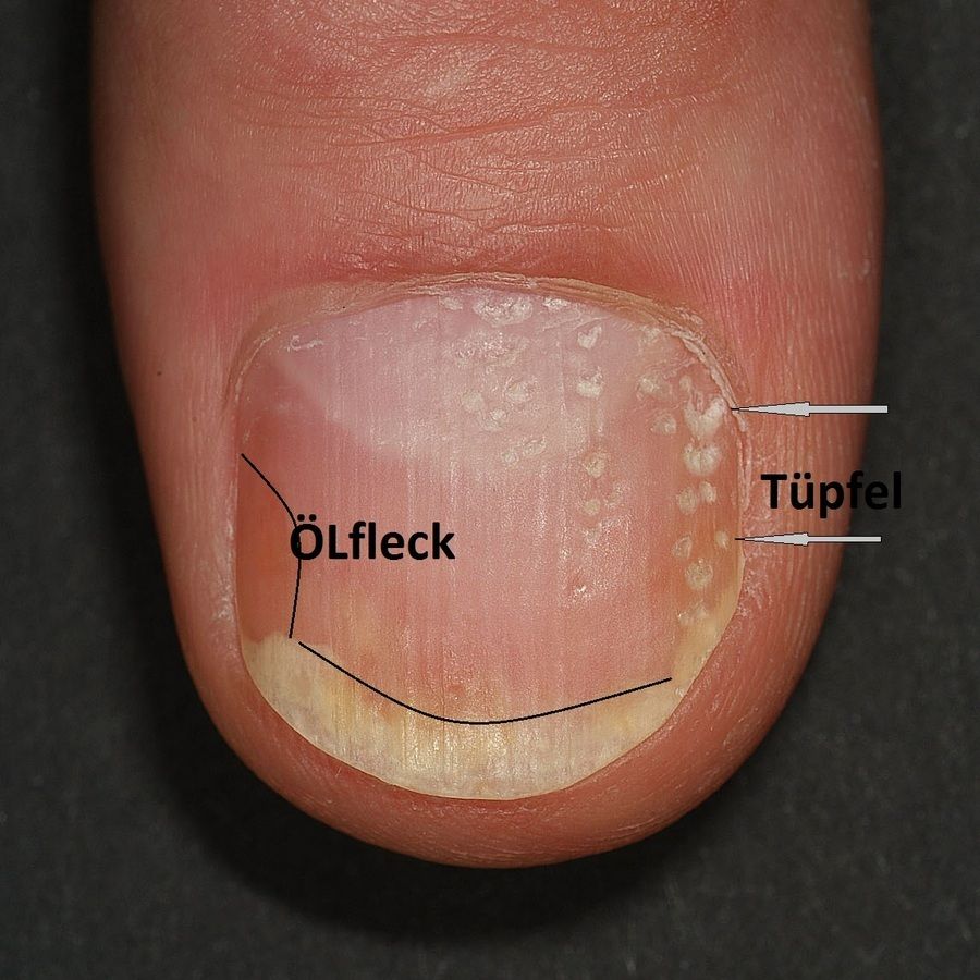 Psoriasis Der Nagel Altmeyers Enzyklopadie Fachbereich Dermatologie