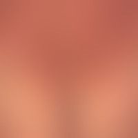 Pityriasis rubra pilaris (a... Pityriasis rubra pilaris (adulter Typ) Detailansicht: seit Jahren chronisch-rezidivierender Verla...