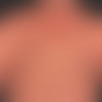 Pityriasis rubra pilaris (a... Pityriasis rubra pilaris (adulter Typ): seit Jahren chronisch-rezidivierender Verlauf mit Phasen ...