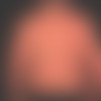 Pityriasis rubra pilaris (a... Pityriasis rubra pilaris (adulter Typ): seit Jahren chronisch-rezidivierender Verlauf mit Phasen ...