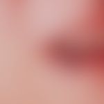 Angioma seniles of the lips (also lip margin angioma): a soft, completely compressible, symptom-f...
